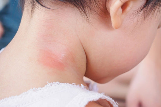 Safe & Effective Mosquito Repellent for Kids and Babies (Parent’s Guide)